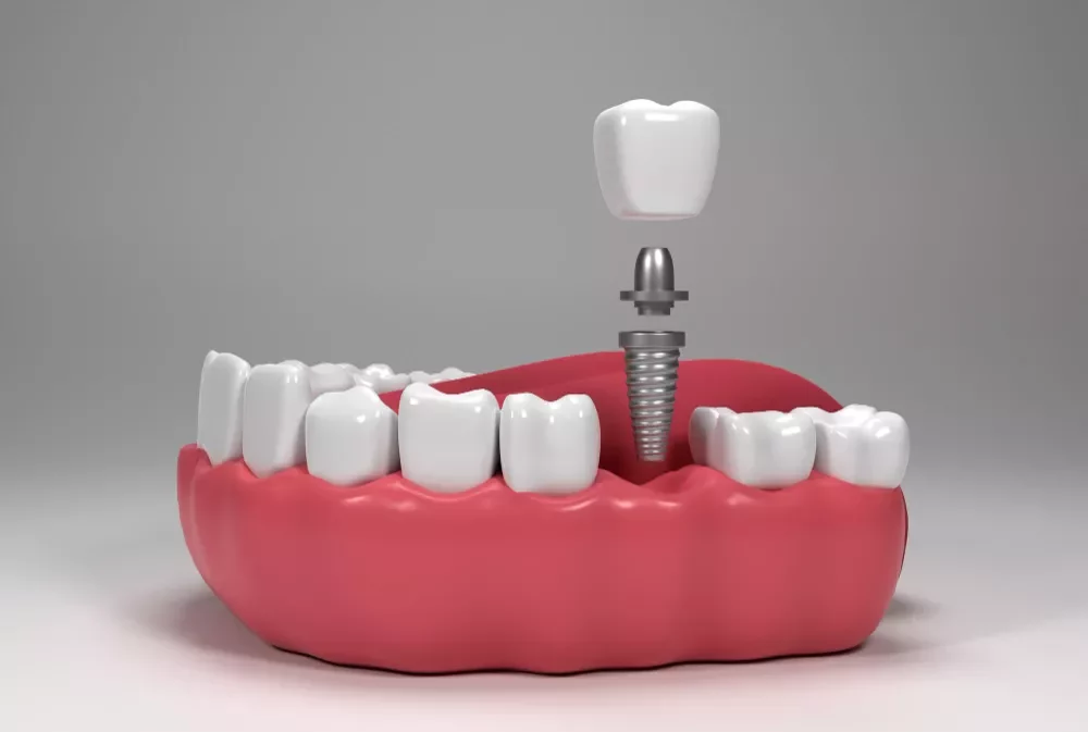 Dental Implant